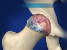 Osteoarthritis of the Hip - KOC Ortho